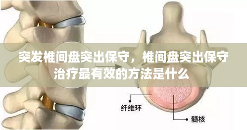 突發(fā)椎間盤(pán)突出保守，椎間盤(pán)突出保守治療最有效的方法是什么 