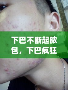 下巴不斷起膿包，下巴瘋狂長(cháng)膿包 