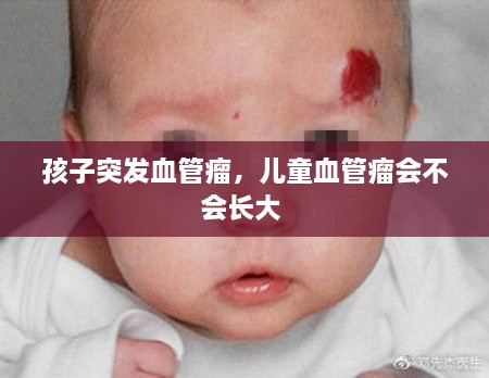 孩子突發(fā)血管瘤，兒童血管瘤會(huì )不會(huì )長(cháng)大 